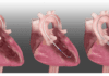 Israel: Magenta Medical closes US$105m financing led by Novo Holdings